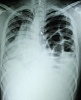 Xray of diaphragm rupture