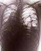 Negative Xray of diaphragm rupture