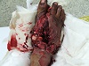 Foot injury